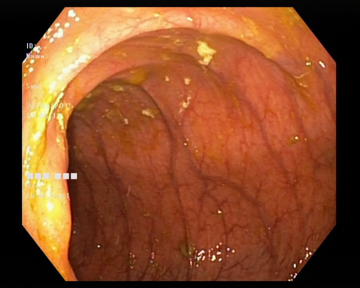Норма: слизистая толстой кишки