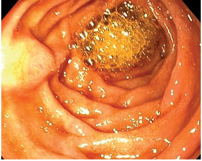 Дуоденоскопия. БСДК на внутренней полуокружности нисходящей части, форма «полусферическая».
