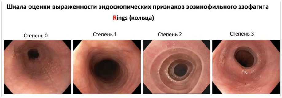 Шкала EREFS: Rings (кольца), степени 0–3