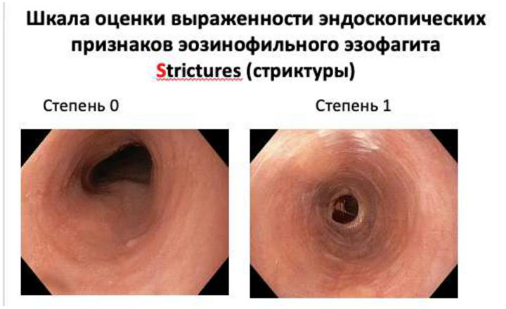 Шкала EREFS: Strictures (стриктуры), степени 0–1